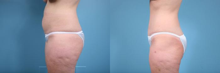 Before & After Tummy Tuck Case 73 View #2 View in Chicago, IL