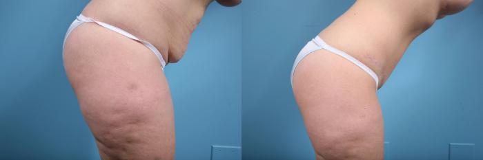 Before & After Tummy Tuck Case 73 View #4 View in Chicago, IL