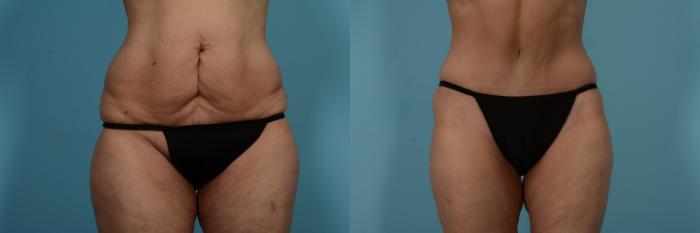 Before & After Tummy Tuck Case 733 Front View in Chicago, IL