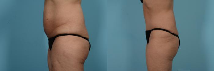 Before & After Tummy Tuck Case 733 Left Side View in Chicago, IL