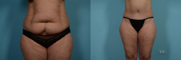 Before & After Tummy Tuck Case 734 Front View in Chicago, IL