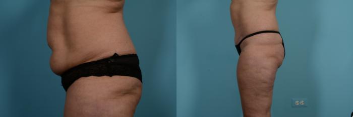 Before & After Tummy Tuck Case 734 Left Side View in Chicago, IL