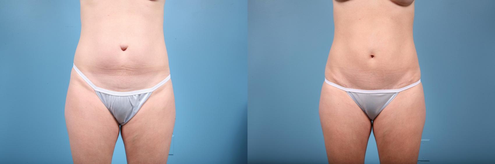 Before & After Tummy Tuck Case 75 View #1 View in Chicago, IL