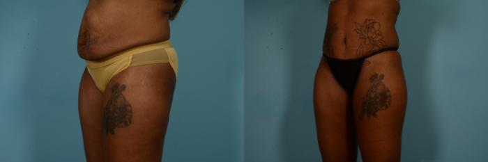 Before & After Tummy Tuck Case 840 Left Oblique View in Chicago, IL