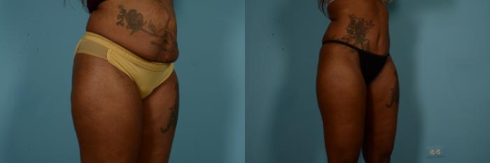 Before & After Tummy Tuck Case 840 Right Oblique View in Chicago, IL