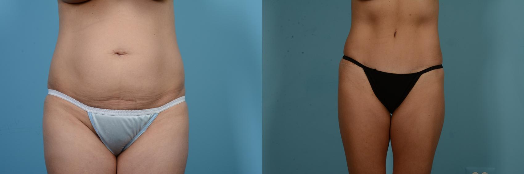 Before & After Tummy Tuck Case 842 Front View in Chicago, IL