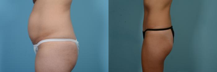 Before & After Tummy Tuck Case 842 Left Side View in Chicago, IL