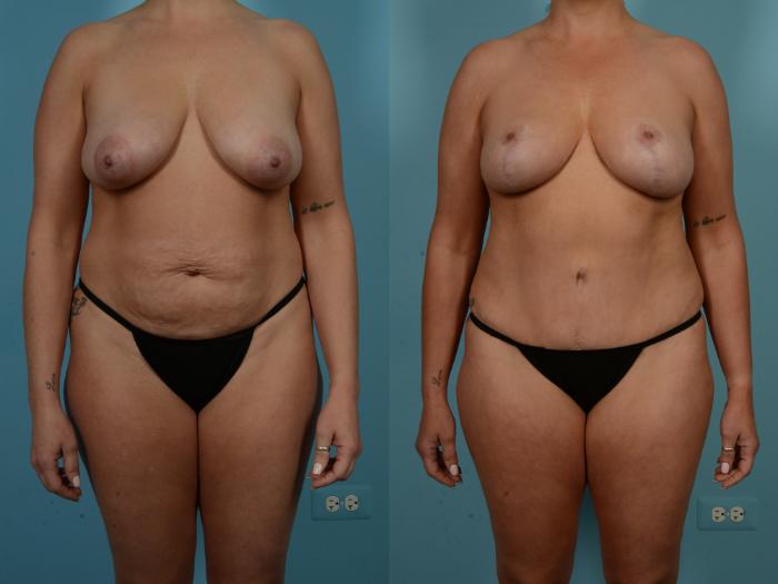 Before & After Tummy Tuck Case 900 Front View in Chicago, IL