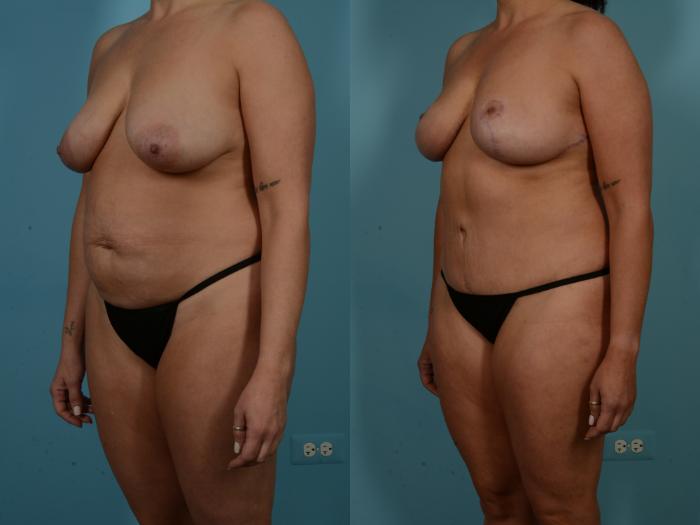Before & After Tummy Tuck Case 900 Left Oblique View in Chicago, IL