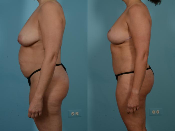 Before & After Tummy Tuck Case 900 Left Side View in Chicago, IL