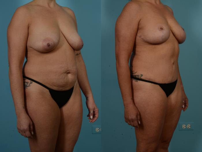 Before & After Tummy Tuck Case 900 Right Oblique View in Chicago, IL