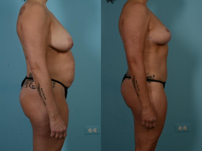 Before & After Tummy Tuck Case 900 Right Side View in Chicago, IL