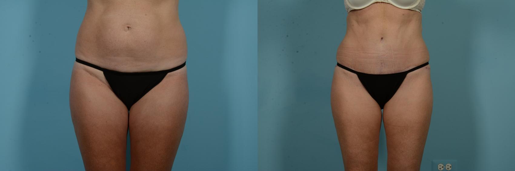 Before & After Tummy Tuck Case 971 Front View in Chicago, IL