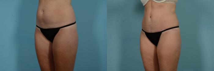 Before & After Tummy Tuck Case 971 Left Oblique View in Chicago, IL
