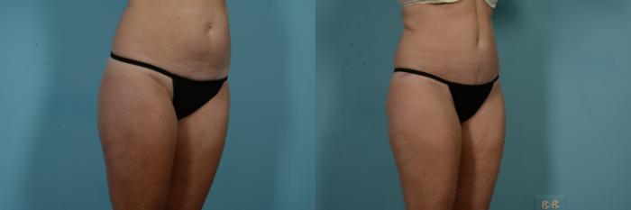 Before & After Tummy Tuck Case 971 Right Oblique View in Chicago, IL