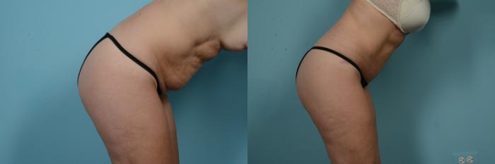Before & After Tummy Tuck Case 971 Right Side View in Chicago, IL