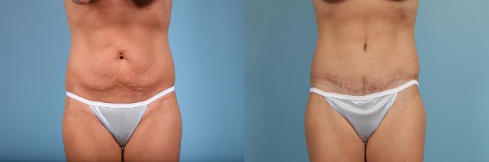 Before & After Tummy Tuck by Dr. Mustoe Case 103 View #1 View in Chicago, IL