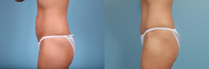 Before & After Tummy Tuck by Dr. Mustoe Case 103 View #2 View in Chicago, IL
