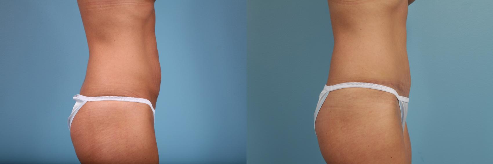Before & After Tummy Tuck by Dr. Mustoe Case 103 View #3 View in Chicago, IL