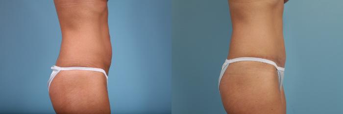 Before & After Tummy Tuck by Dr. Mustoe Case 103 View #3 View in Chicago, IL