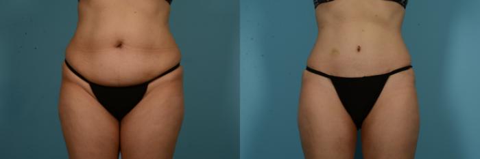 Before & After Tummy Tuck by Dr. Mustoe Case 1049 Front View in Chicago, IL