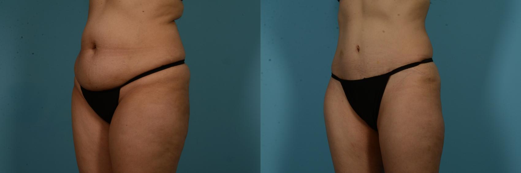Before & After Tummy Tuck by Dr. Mustoe Case 1049 Left Oblique View in Chicago, IL