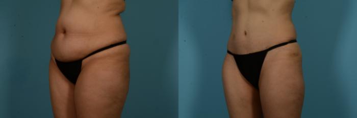 Before & After Tummy Tuck by Dr. Mustoe Case 1049 Left Oblique View in Chicago, IL