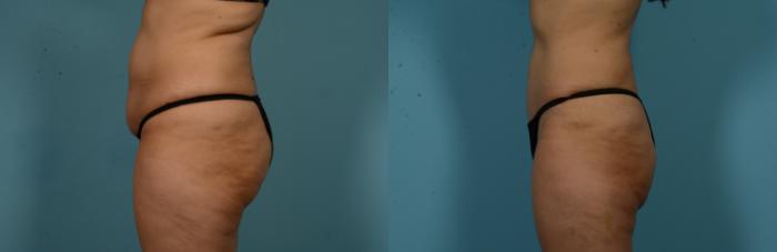 Before & After Tummy Tuck by Dr. Mustoe Case 1049 Left Side View in Chicago, IL