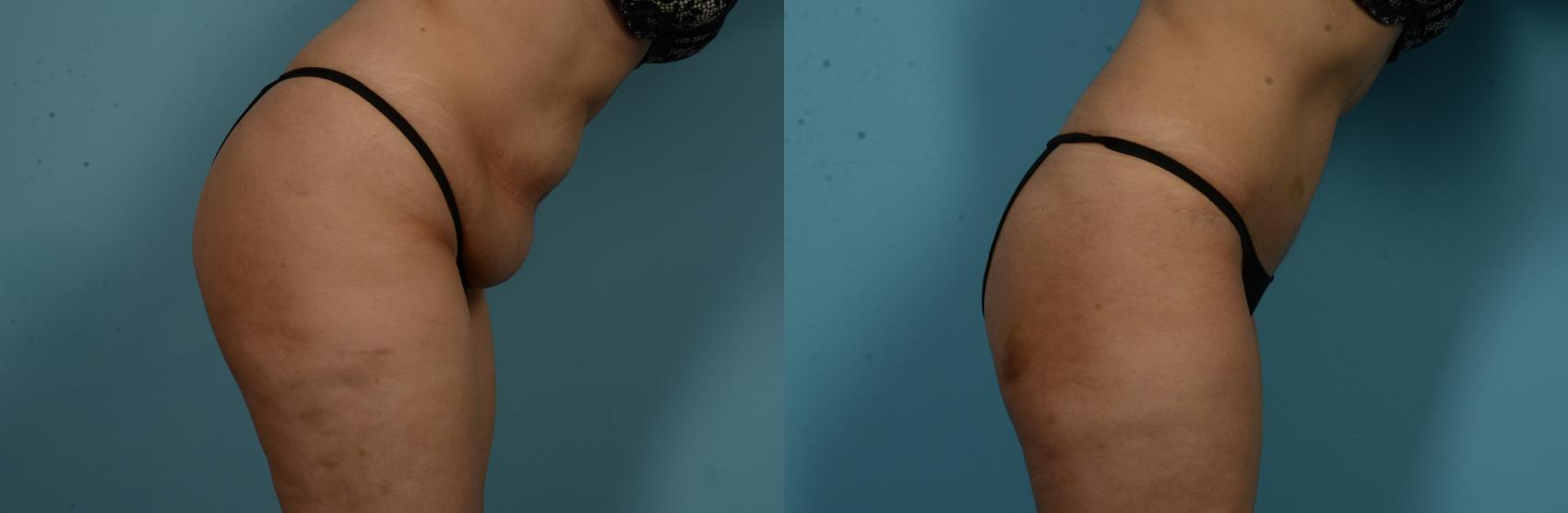 Before & After Tummy Tuck by Dr. Mustoe Case 1049 Right - forward View in Chicago, IL