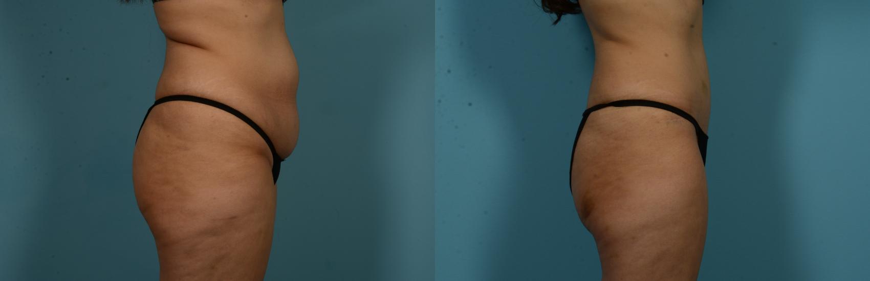 Before & After Tummy Tuck by Dr. Mustoe Case 1049 Right Side View in Chicago, IL