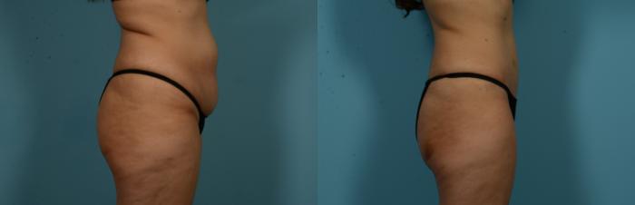 Before & After Tummy Tuck by Dr. Mustoe Case 1049 Right Side View in Chicago, IL