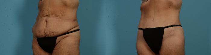 Before & After Tummy Tuck by Dr. Mustoe Case 1051 Left Oblique View in Chicago, IL