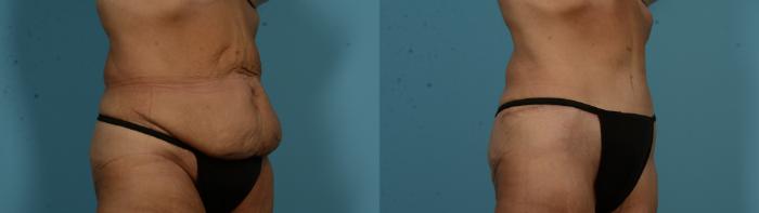Before & After Tummy Tuck by Dr. Mustoe Case 1051 Right Oblique View in Chicago, IL