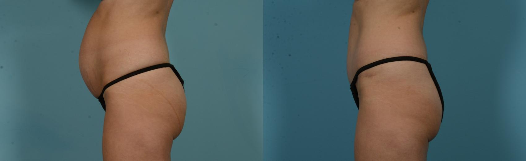 Before & After Tummy Tuck by Dr. Mustoe Case 1056 Left Side View in Chicago, IL