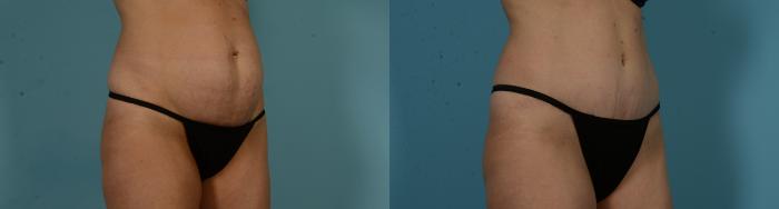 Before & After Tummy Tuck by Dr. Mustoe Case 1056 Right Oblique View in Chicago, IL