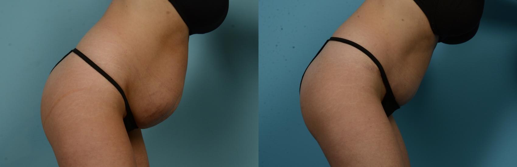 Before & After Tummy Tuck by Dr. Mustoe Case 1056 Right side bend View in Chicago, IL