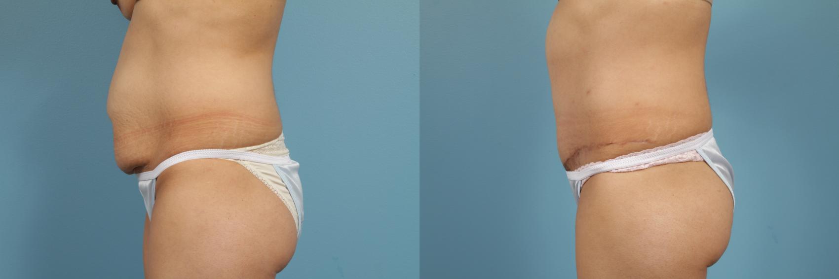 Before & After Tummy Tuck by Dr. Mustoe Case 148 View #2 View in Chicago, IL
