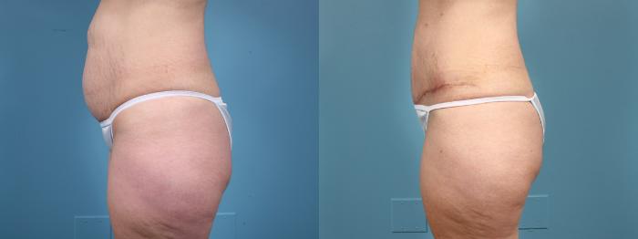 Before & After Tummy Tuck by Dr. Mustoe Case 15 View #2 View in Chicago, IL