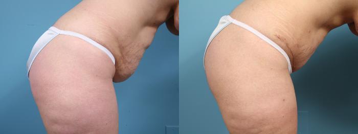 Before & After Tummy Tuck by Dr. Mustoe Case 15 View #3 View in Chicago, IL