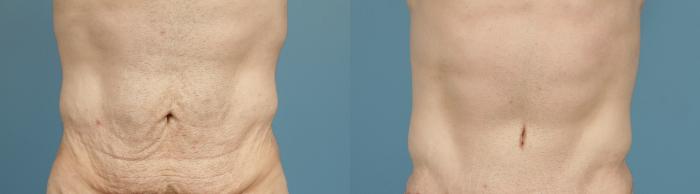 Before & After Tummy Tuck by Dr. Mustoe Case 166 Front View in Chicago, IL