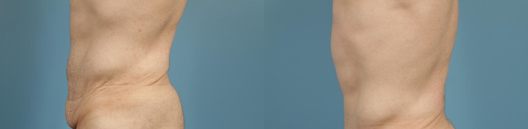 Before & After Tummy Tuck by Dr. Mustoe Case 166 Left Side View in Chicago, IL