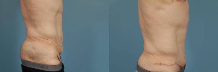 Before & After Tummy Tuck by Dr. Mustoe Case 166 View #3 View in Chicago, IL
