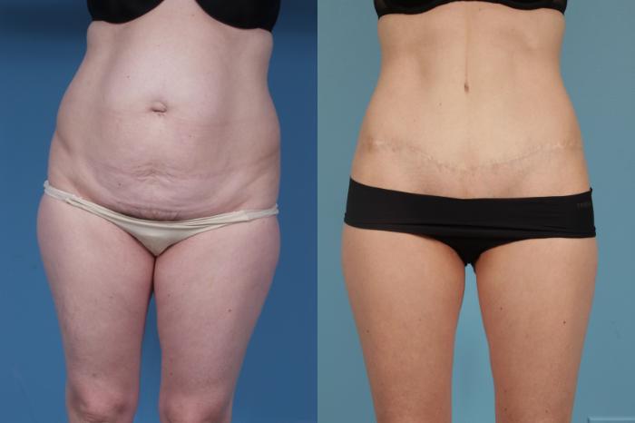Before & After Tummy Tuck by Dr. Mustoe Case 176 View #1 View in Chicago, IL