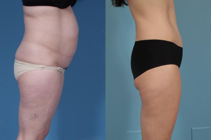Before & After Tummy Tuck by Dr. Mustoe Case 176 View #3 View in Chicago, IL