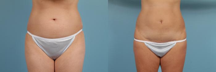 Before & After Tummy Tuck by Dr. Mustoe Case 192 View #1 View in Chicago, IL