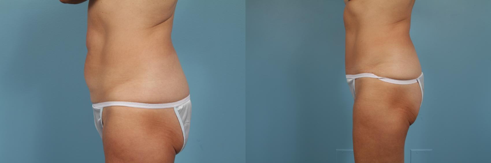Before & After Tummy Tuck by Dr. Mustoe Case 203 View #2 View in Chicago, IL