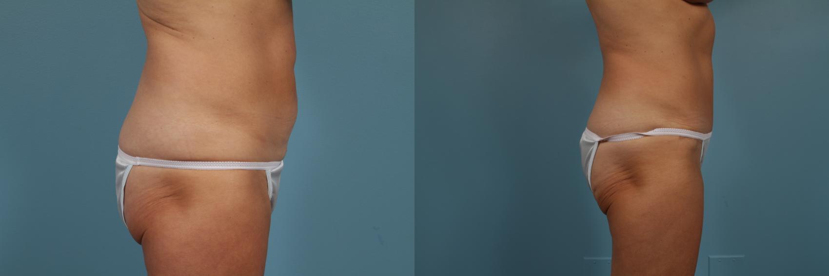 Before & After Tummy Tuck by Dr. Mustoe Case 203 View #3 View in Chicago, IL
