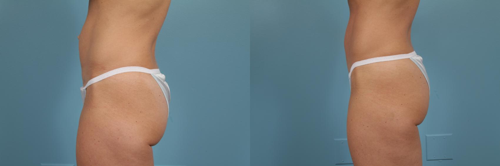 Before & After Tummy Tuck by Dr. Mustoe Case 212 View #2 View in Chicago, IL