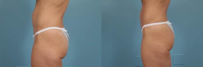 Before & After Tummy Tuck by Dr. Mustoe Case 212 View #2 View in Chicago, IL