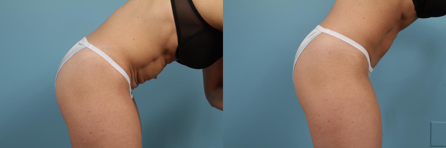 Before & After Tummy Tuck by Dr. Mustoe Case 212 View #3 View in Chicago, IL